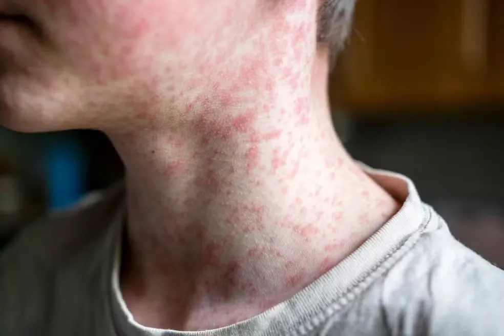 Surto de sarampo na Bolívia preocupa o Brasil. Manchas no corpo estão entre os sintomas da doença. — Foto: Adobe Stock