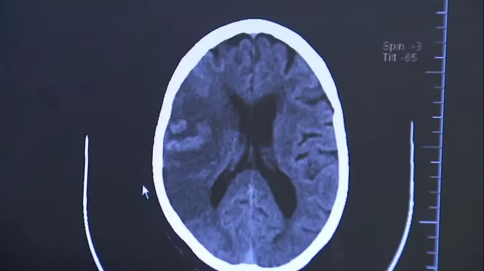 Durante o AVC isquêmico há um bloqueio na artéria, levando à falta de sangue e morte das células cerebrais. Já no hemorrágico, o sangue extravasa por ruptura de um vaso — Foto: Reprodução EPTV